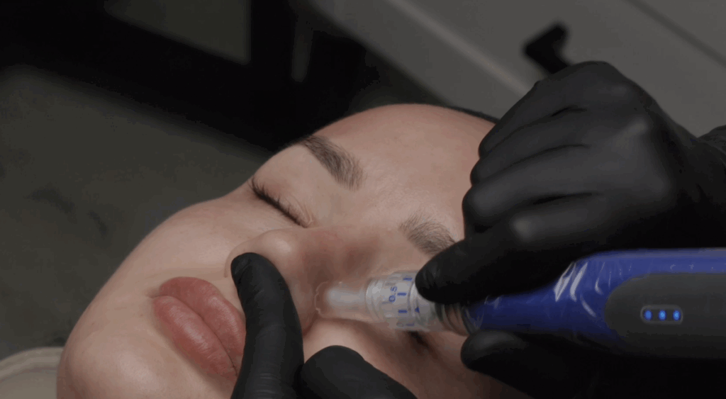 A close-up of a patient receiving SkinPen microneedling for wrinkles near Minneapolis at Honey Aesthetics. The provider glides the SkinPen device along her skin to promote a youthful appearance.