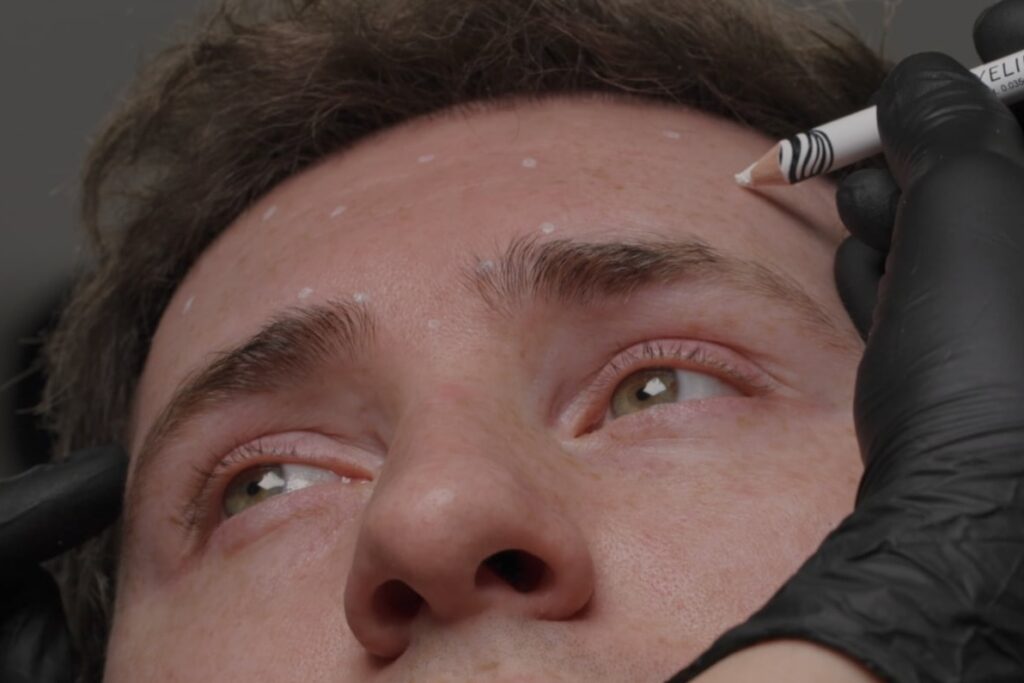A male patient relaxes comfortably as a provider at Honey Aesthetics makes marks with a white pencil on his upper face for forehead wrinkle Botox near Minneapolis.